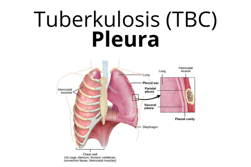 TBC Pleura