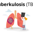 Tuberkulosis TBC