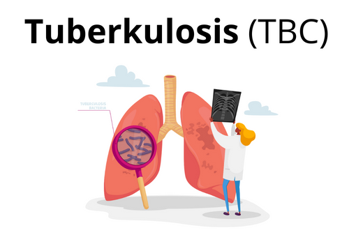Tuberkulosis TBC