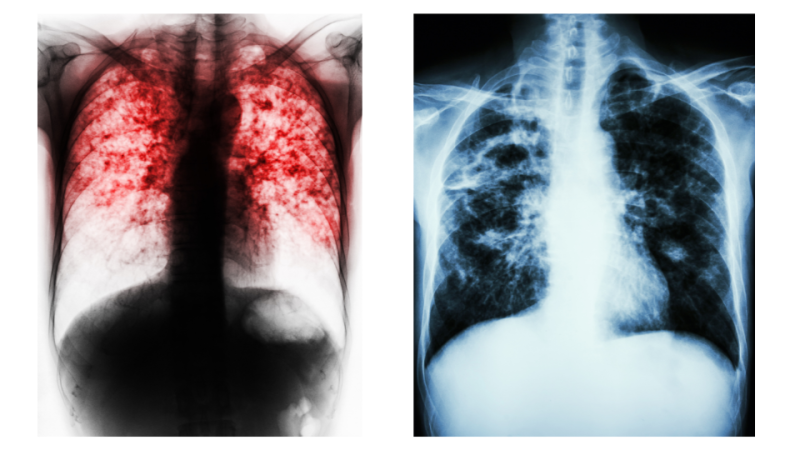 Apa Itu Tuberkulosis Tbc Yayasan Kncv Indonesia 5653